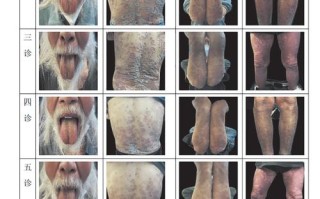 职业性皮肤病如何演变至今？